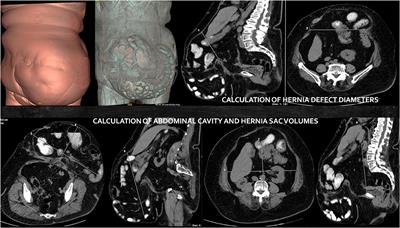 Preoperative Botulinum Toxin and Progressive Pneumoperitoneum in Loss of Domain Hernias—Our First 100 Cases